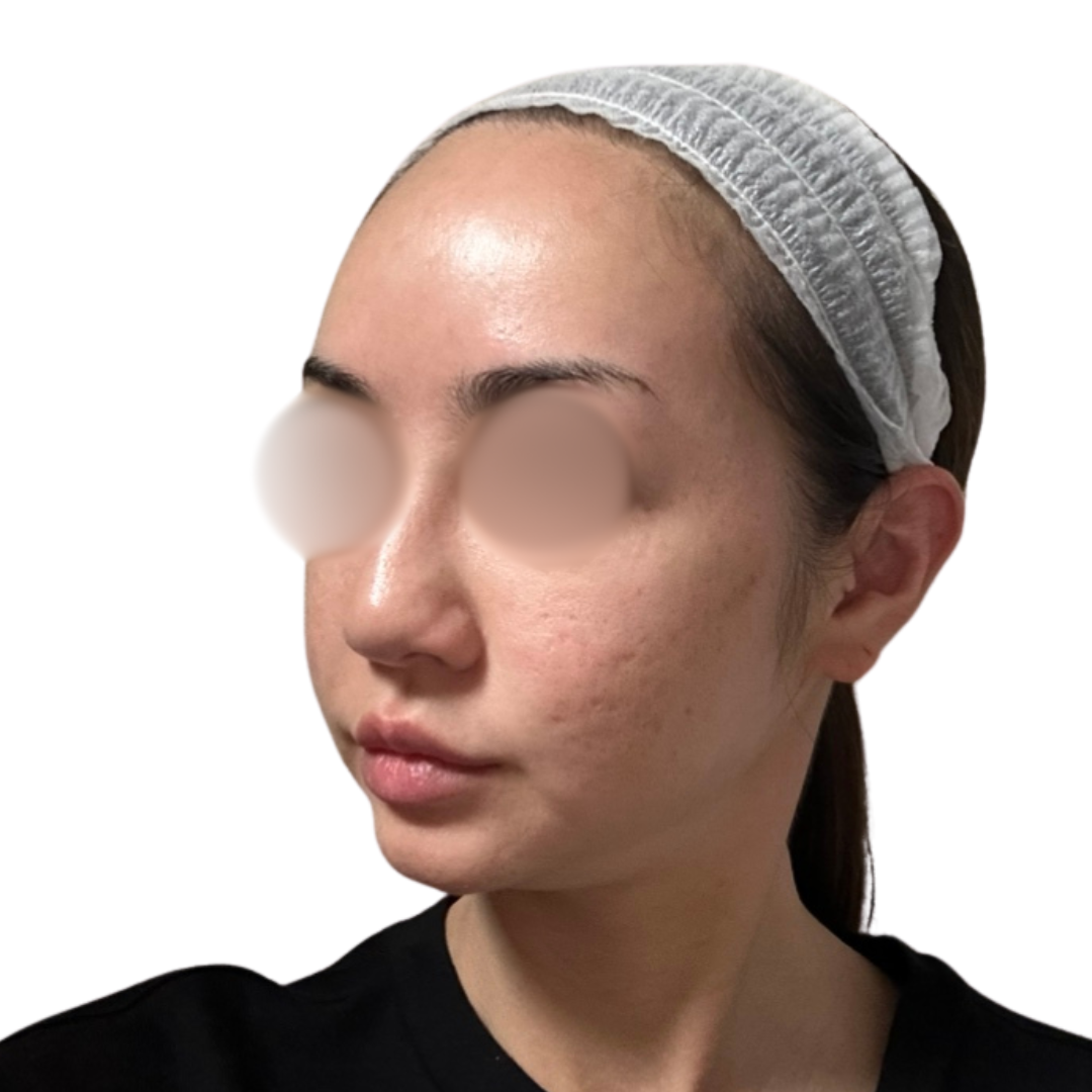 サブシジョン（クレーター治療）